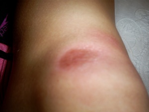 1 bruise on my knee